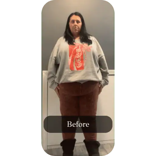Before Weightloss treatments at Elara
